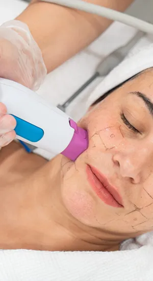 Aplicação Thermage FLX